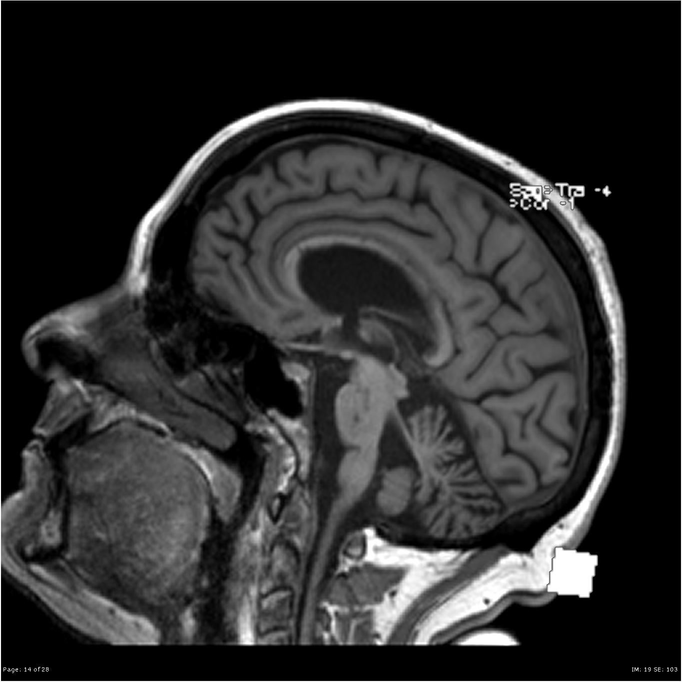 Chronic hypertensive encephalopathy | Image | Radiopaedia.org