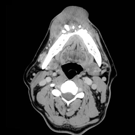 Mandibular lesions | Radiology Reference Article | Radiopaedia.org