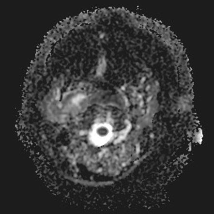 Parotid adenoidcystic carcinoma with carotid space spread | Image ...