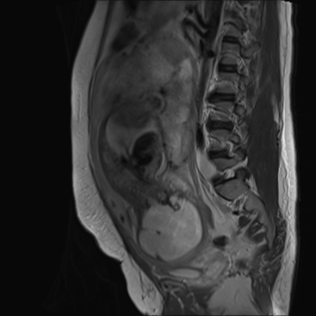 Bilobed Placenta Accreta Radiology Case Radiopaedia Org