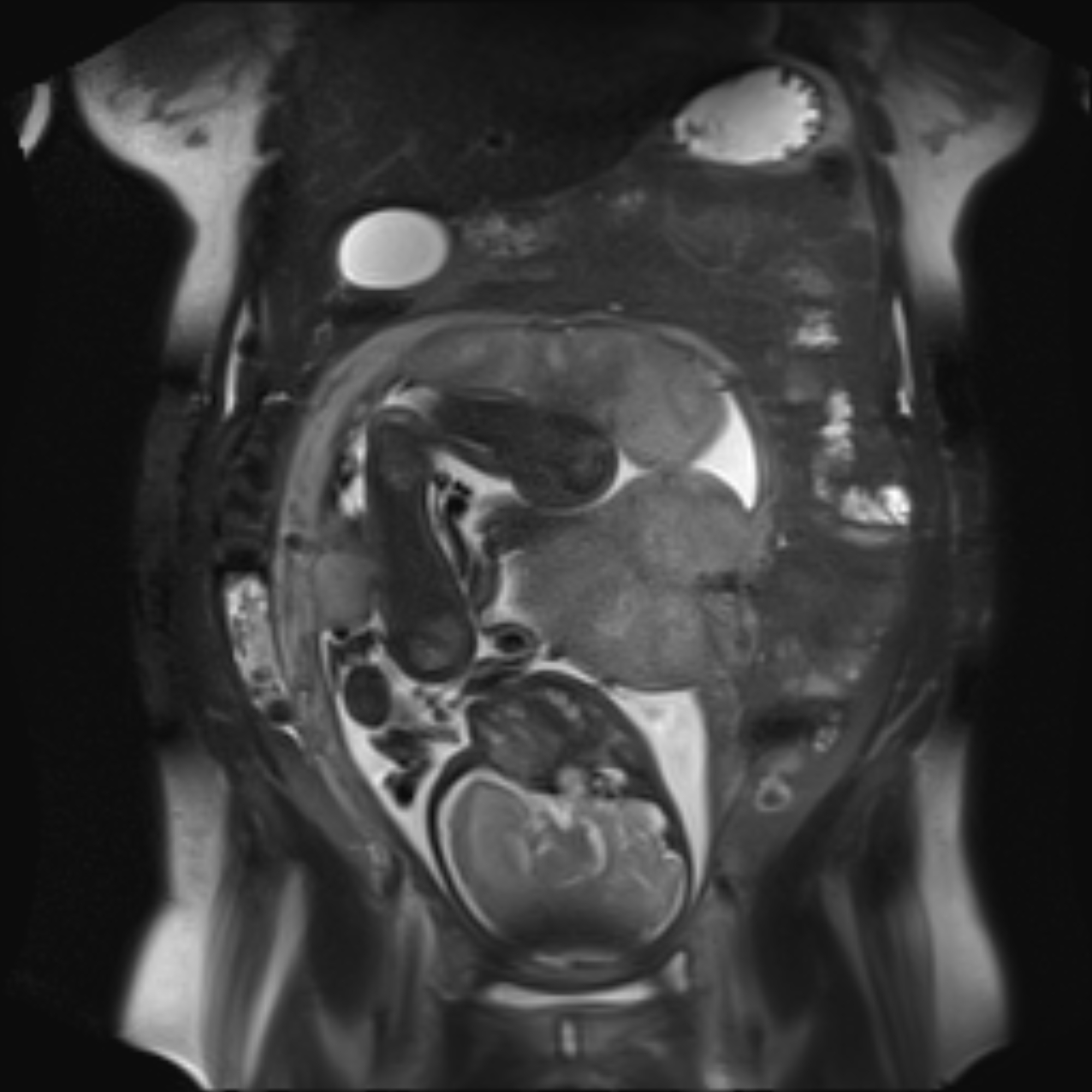 Bilobed placenta accreta | Image | Radiopaedia.org