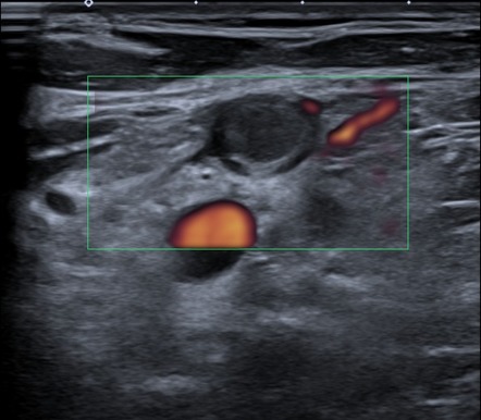 Left subclavian vein thrombosis | Image | Radiopaedia.org