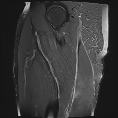 Biceps femoris injury - BAC grade 3c | Image | Radiopaedia.org