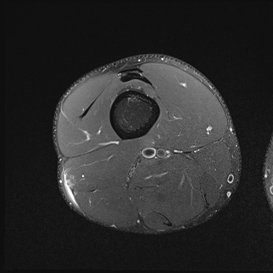 Hamstring injury - grade BAC 2c with re-injury | Image | Radiopaedia.org