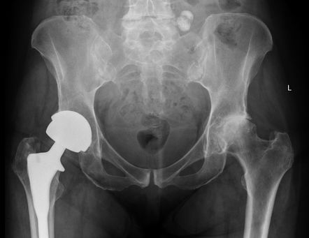 Hip arthroplasty (overview) | Radiology Reference Article | Radiopaedia.org