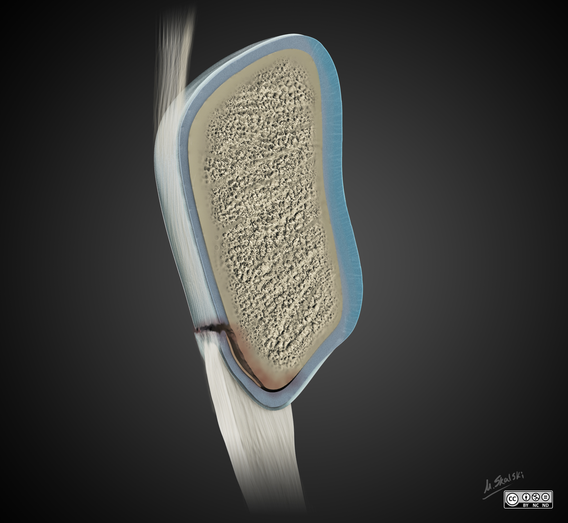 Patellar sleeve avulsion - illustrations | Image | Radiopaedia.org