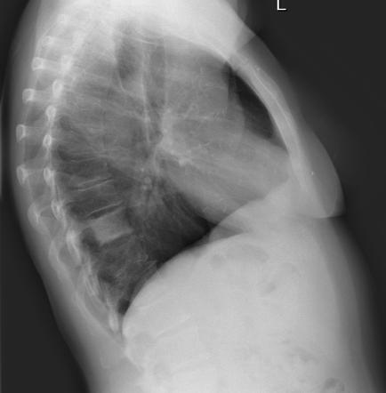 Ivory vertebra | Radiology Reference Article | Radiopaedia.org