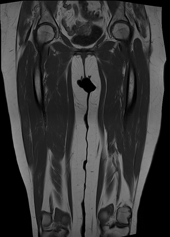 Hamstring Origin Complex Avulsion Image Radiopaedia Org