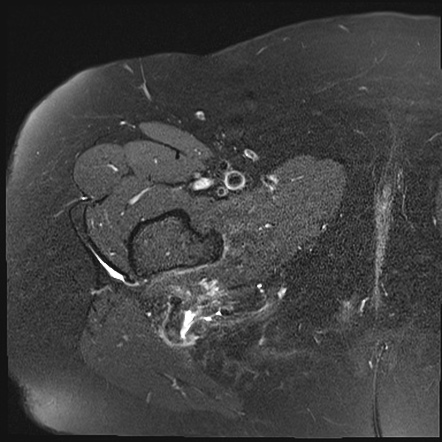 Hamstring Origin Complex Avulsion Image Radiopaedia Org