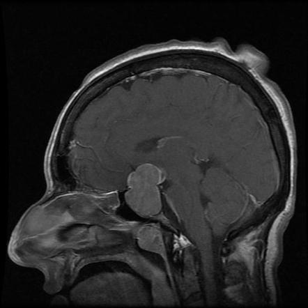 Pituitary Macroadenoma | Radiology Case | Radiopaedia.org