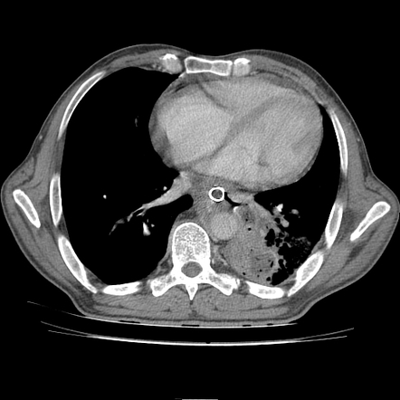 Oesophageal cancer complicated by oesophagopulmonary fistula and lung ...