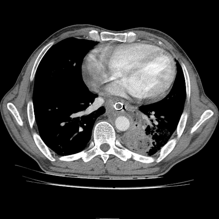 Esophageal cancer complicated by oesophagopulmonary fistula and lung ...