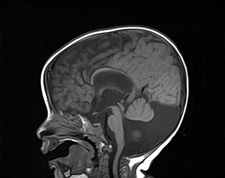 Dandy-Walker malformation with dysgenesis of the corpus callosum and ...