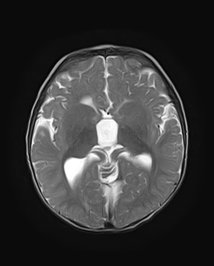 Dandy-Walker malformation with dysgenesis of the corpus callosum and ...