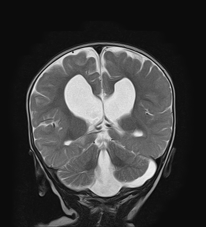 Dandy-Walker malformation with dysgenesis of the corpus callosum and ...