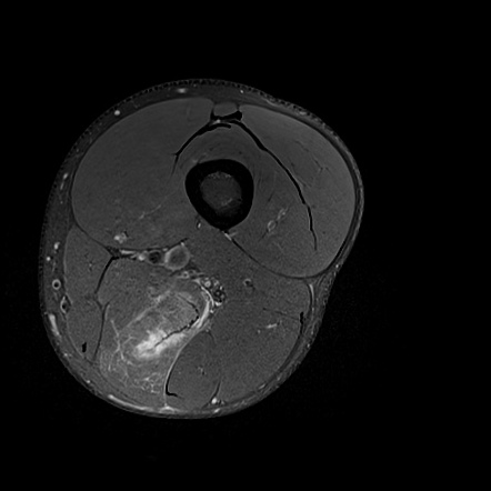 Semimembranosus injury - BAC grade 3c | Radiology Case | Radiopaedia.org