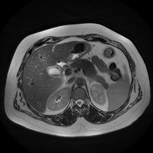 Acute Calcular Cholecystitis And Mirizzi Syndrome | Image | Radiopaedia.org