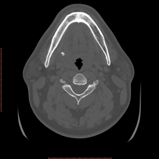 Chronic Submandibular Sialolithiasis Image