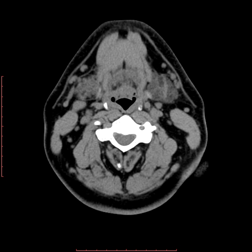 Chronic submandibular sialolithiasis | Image | Radiopaedia.org