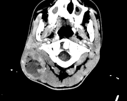 Acute mastoiditis with retroauricular abscess | Image | Radiopaedia.org