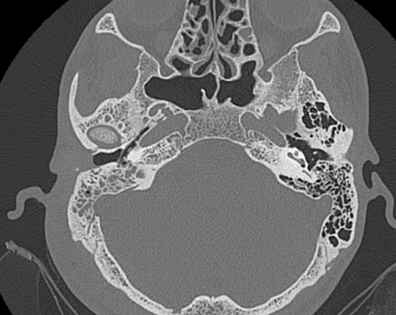 Acute mastoiditis with retroauricular abscess | Image | Radiopaedia.org