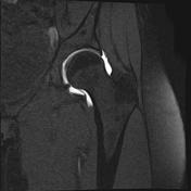 Hip joint capsule | Radiology Reference Article | Radiopaedia.org