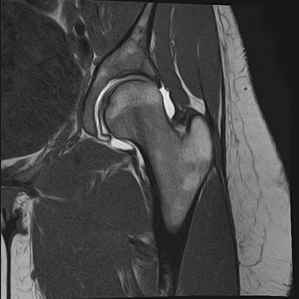 Labral tear in the hip joint Image