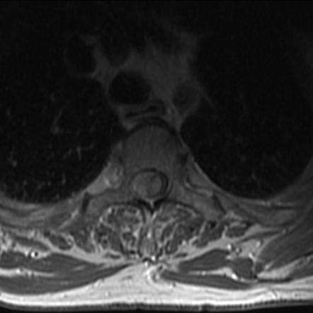 Malignant Spinal Cord Compression From Glioblastoma Drop Metastasis