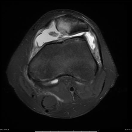 Patellar subluxation store mri