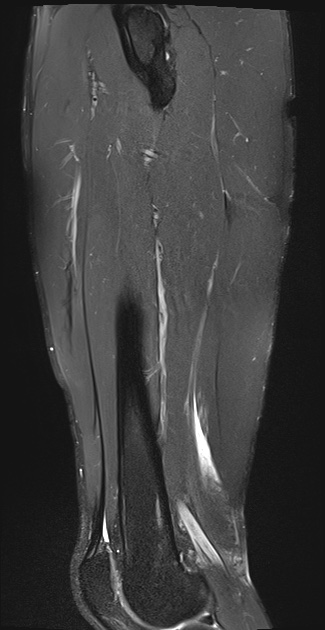 Hamstring Injury - BAC Grade 2a | Image | Radiopaedia.org