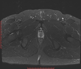 Pilonidal Sinus | Image | Radiopaedia.org