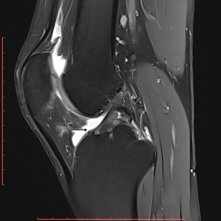 Partial tear of posterior cruciate ligament with infrapatellar plica ...