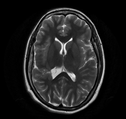 Closed lip schizencephaly | Image | Radiopaedia.org