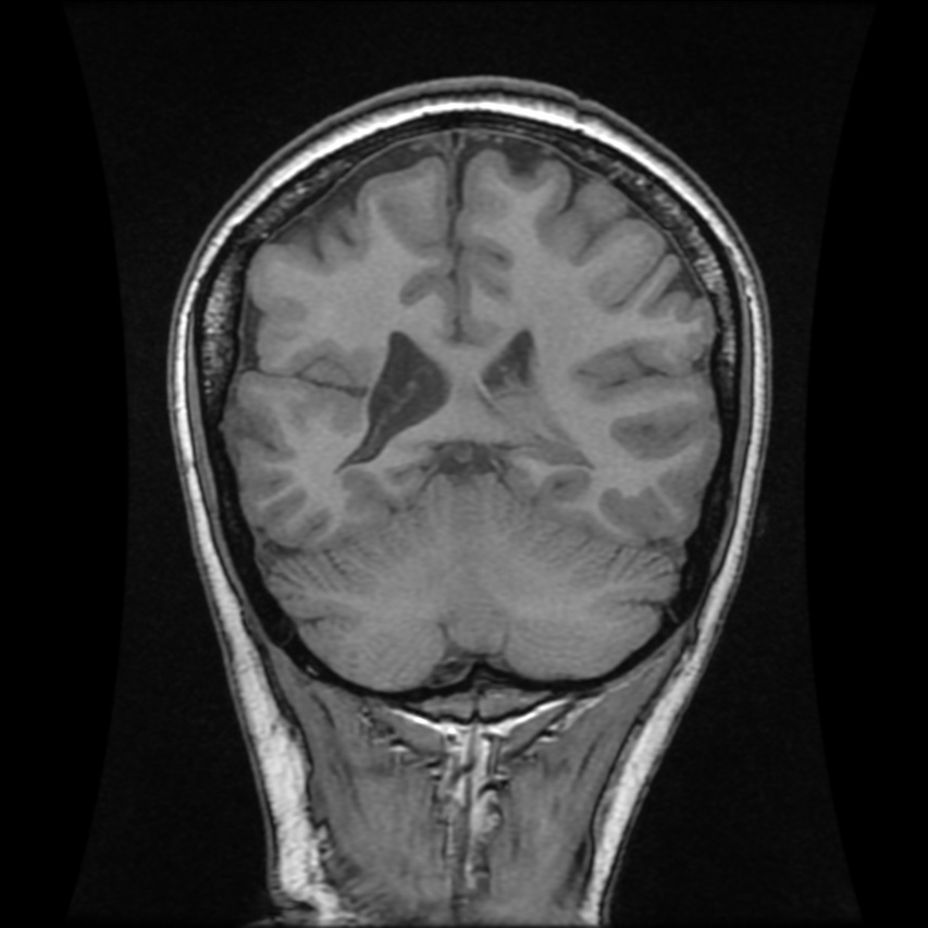 Closed lip schizencephaly | Image | Radiopaedia.org