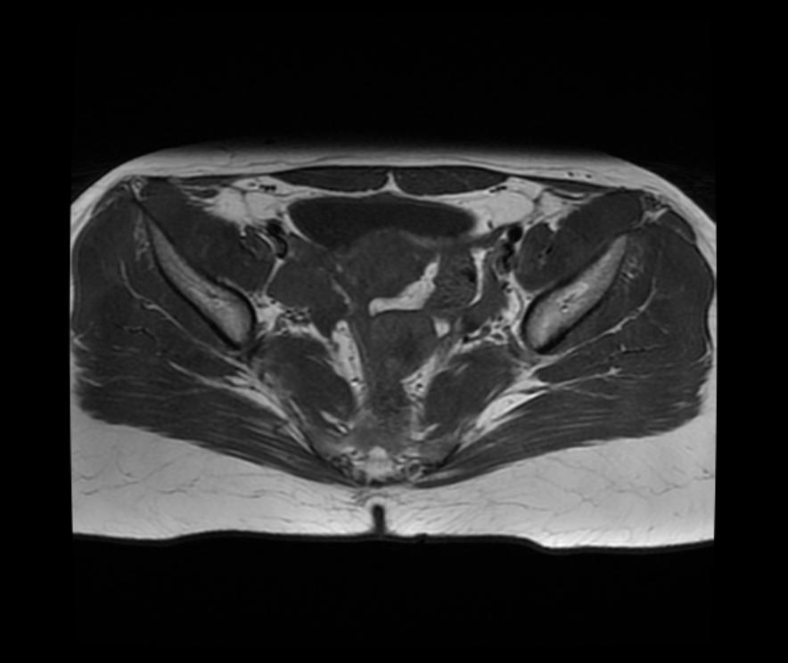 Ovarian cystadenofibroma | Image | Radiopaedia.org