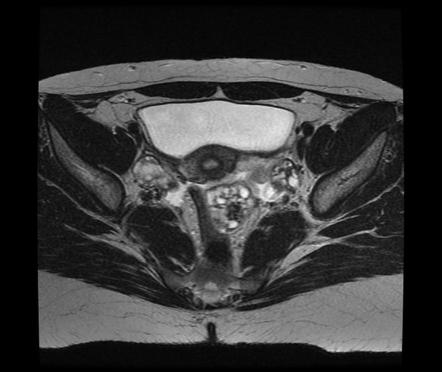 Ovarian cystadenofibroma | Radiology Case | Radiopaedia.org