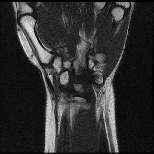 Radial Collateral Ligament Tear Wrist Image