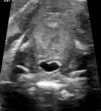 Heart in the mouth (Rorschach radiology) | Radiology Case | Radiopaedia.org