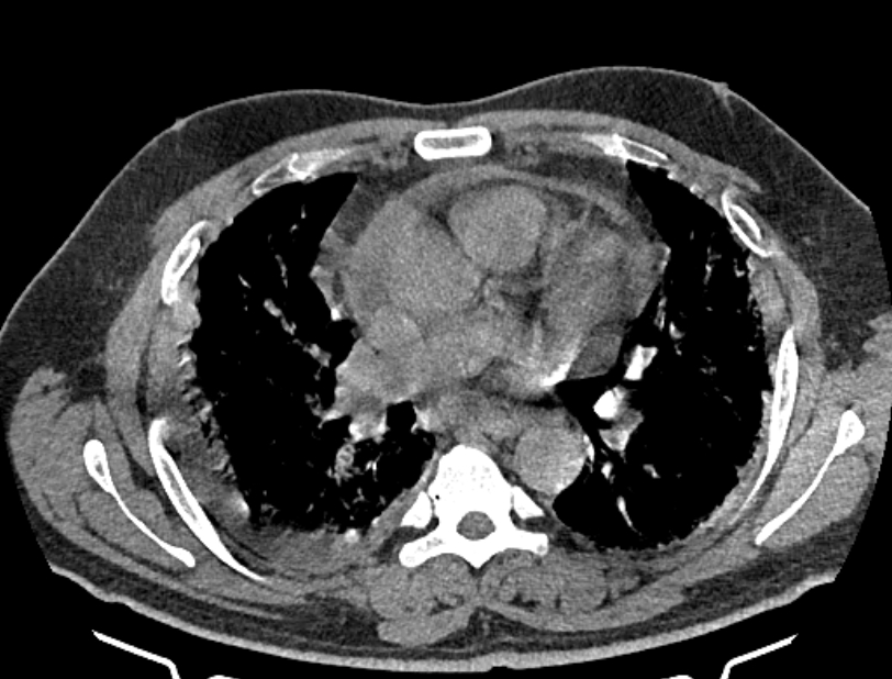 Cardiogenic Pulmonary Edema | Image | Radiopaedia.org