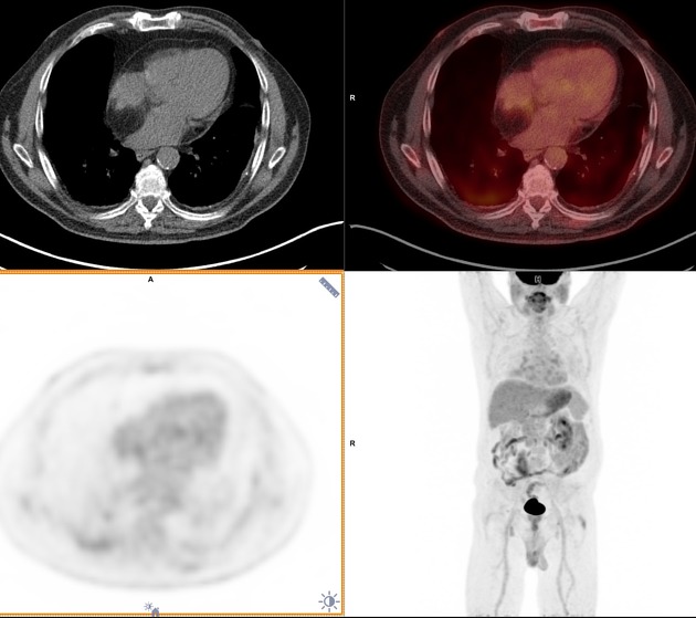 Lipomatous Hypertrophy Of The Interatrial Septum Radiology Reference Article