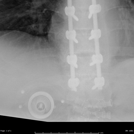 DermaClose external tissue expander device | Image | Radiopaedia.org