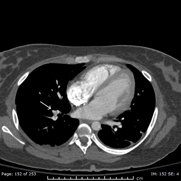 Pulmonary embolism