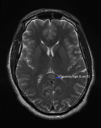 Cerebral malaria | Image | Radiopaedia.org