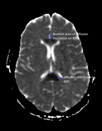 Cerebral malaria | Image | Radiopaedia.org