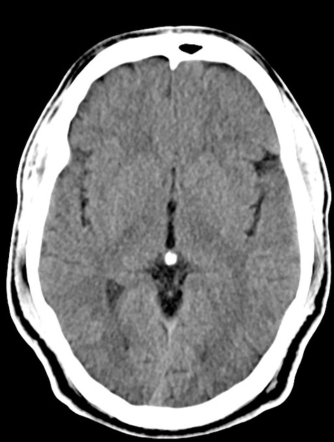 Cerebral Venous Angioma Radiology Case Radiopaedia Org