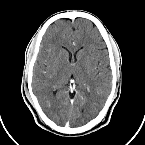 Venous Angioma