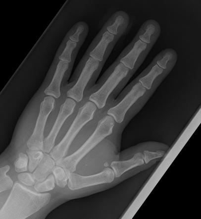 Glass foreign body | Radiology Case | Radiopaedia.org