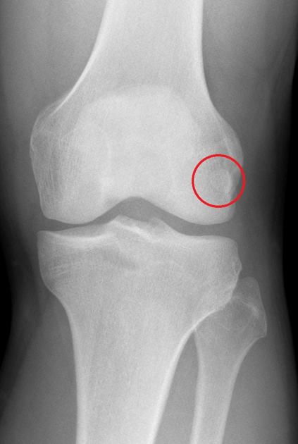 Fabella | Radiology Reference Article | Radiopaedia.org