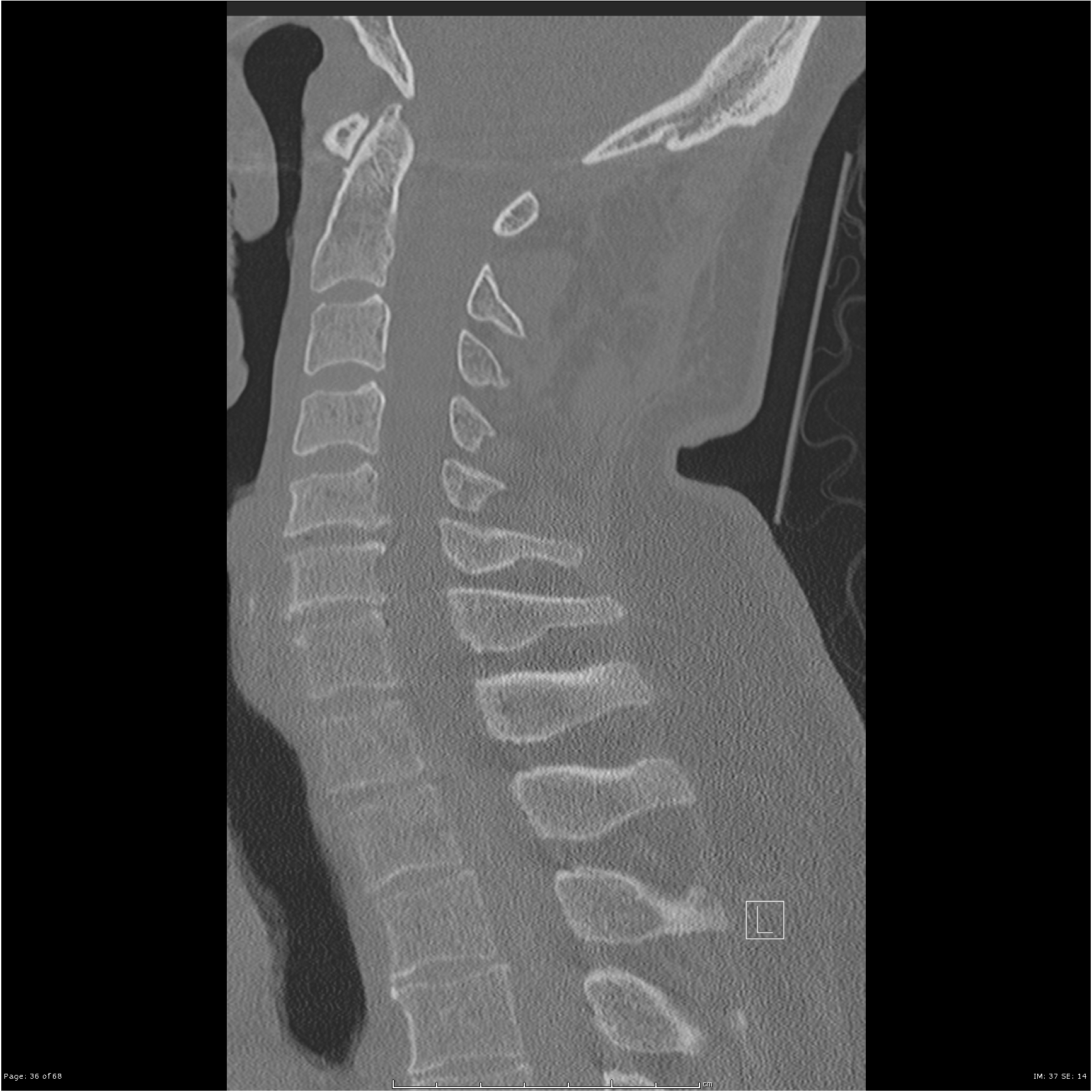 Bilateral cervical ribs | Image | Radiopaedia.org