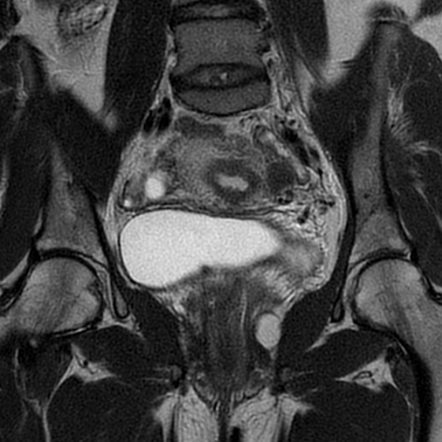 Adenomyosis within a septate uterus | Image | Radiopaedia.org